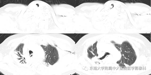 【病例】气管肿瘤2例CT影像诊断 【病例】气管肿瘤2例CT影像诊断