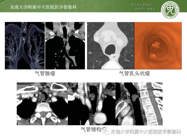 【病例】气管肿瘤2例CT影像诊断 【病例】气管肿瘤2例CT影像诊断