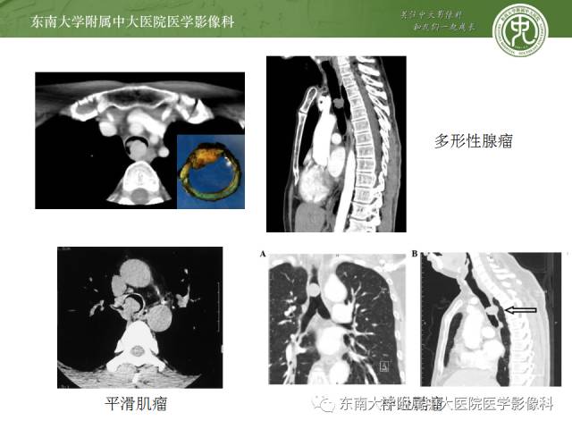 【病例】气管肿瘤2例CT影像诊断 【病例】气管肿瘤2例CT影像诊断