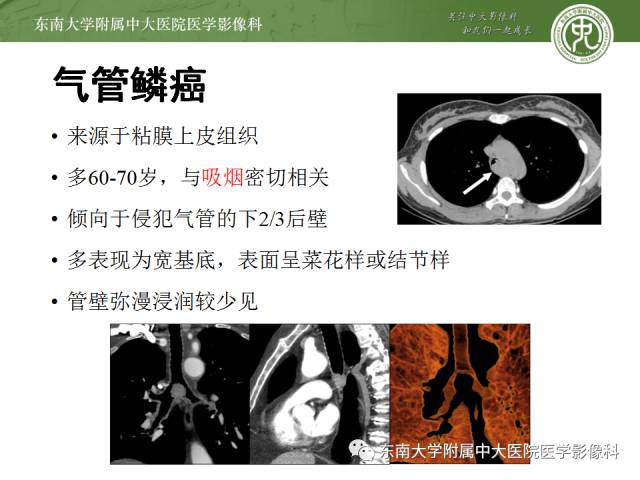 【病例】气管肿瘤2例CT影像诊断 【病例】气管肿瘤2例CT影像诊断