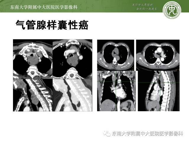 【病例】气管肿瘤2例CT影像诊断 【病例】气管肿瘤2例CT影像诊断