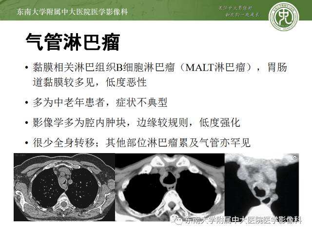 【病例】气管肿瘤2例CT影像诊断 【病例】气管肿瘤2例CT影像诊断