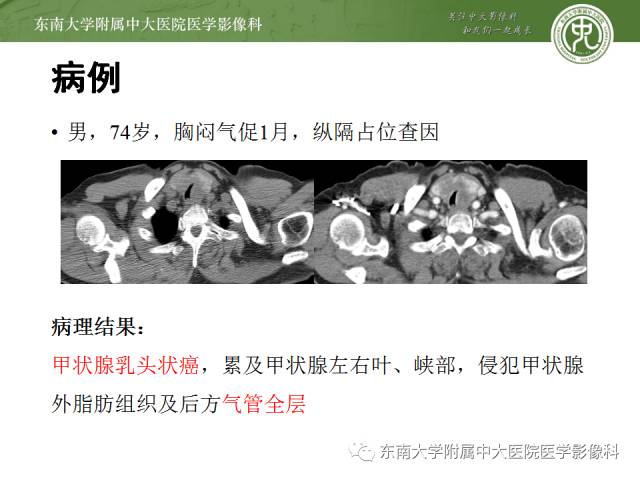 【病例】气管肿瘤2例CT影像诊断 【病例】气管肿瘤2例CT影像诊断