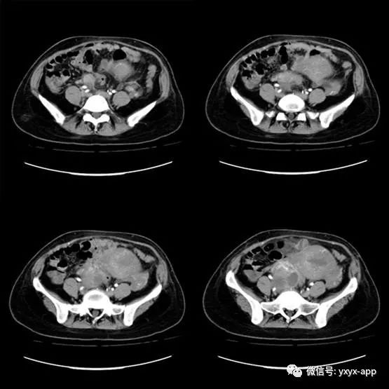 【病例】卵巢囊肿合并化脓性感染1例CT 【病例】卵巢囊肿合并化脓性感染1例CT