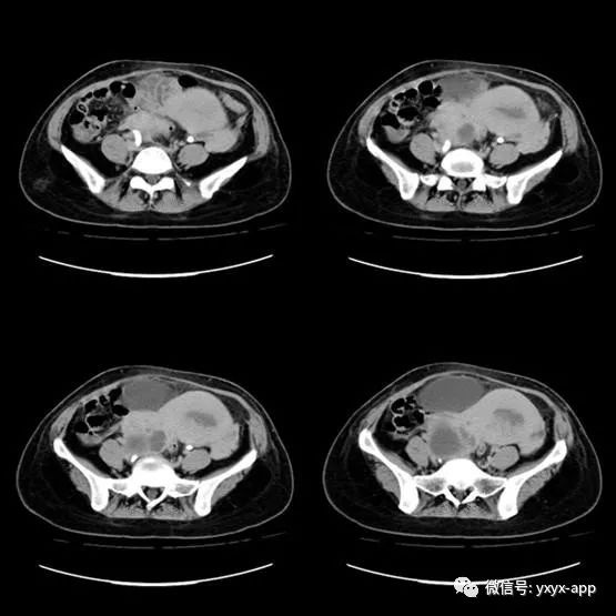 【病例】卵巢囊肿合并化脓性感染1例CT 【病例】卵巢囊肿合并化脓性感染1例CT