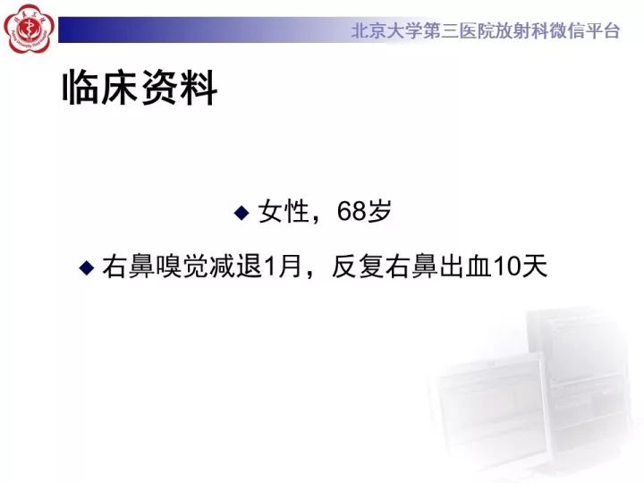 【病例】鼻腔嗅神经母细胞瘤1例CT及MR影像