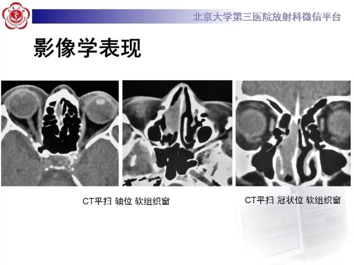 【病例】鼻腔嗅神经母细胞瘤1例CT及MR影像