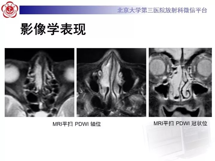 【病例】鼻腔嗅神经母细胞瘤1例CT及MR影像