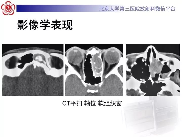 【病例】鼻腔嗅神经母细胞瘤1例CT及MR影像