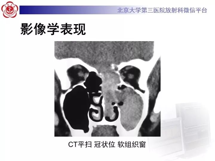 【病例】鼻腔嗅神经母细胞瘤1例CT及MR影像