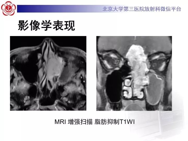 【病例】鼻腔嗅神经母细胞瘤1例CT及MR影像