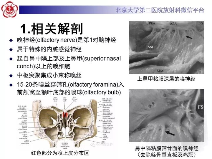 【病例】鼻腔嗅神经母细胞瘤1例CT及MR影像