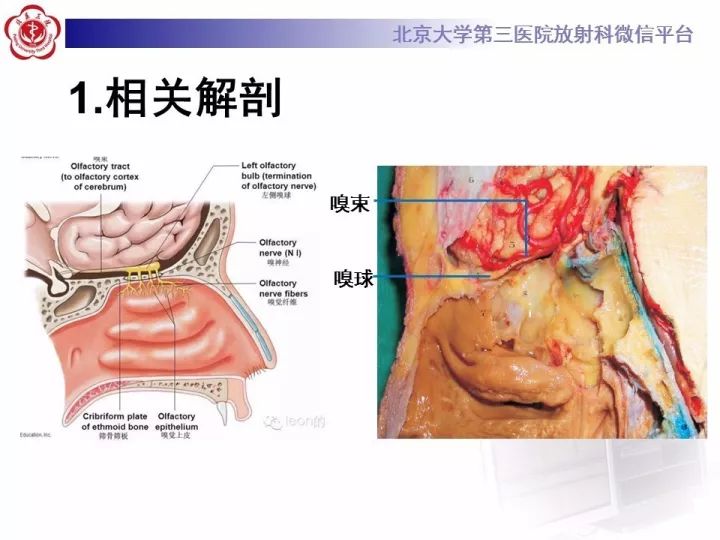 【病例】鼻腔嗅神经母细胞瘤1例CT及MR影像