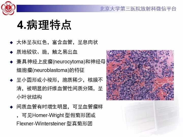 【病例】鼻腔嗅神经母细胞瘤1例CT及MR影像