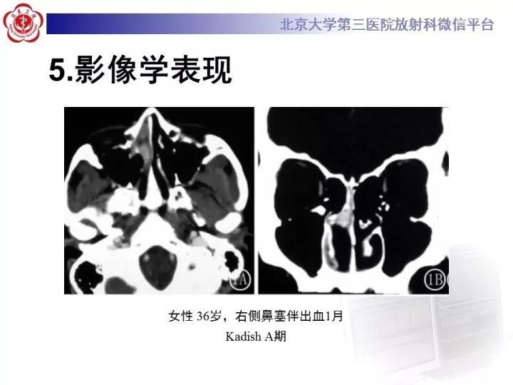 【病例】鼻腔嗅神经母细胞瘤1例CT及MR影像