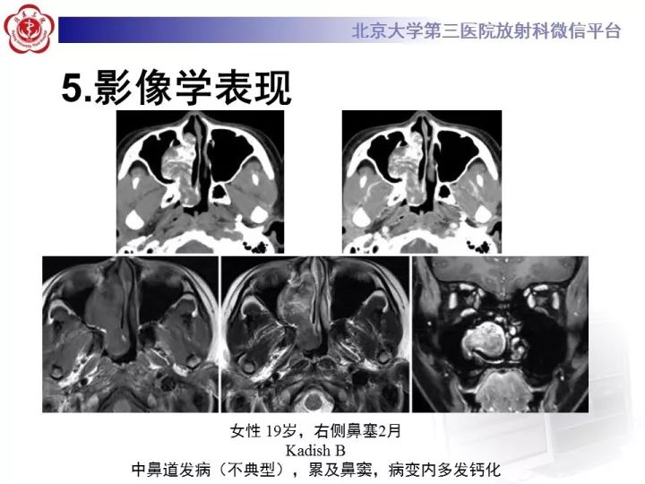 【病例】鼻腔嗅神经母细胞瘤1例CT及MR影像