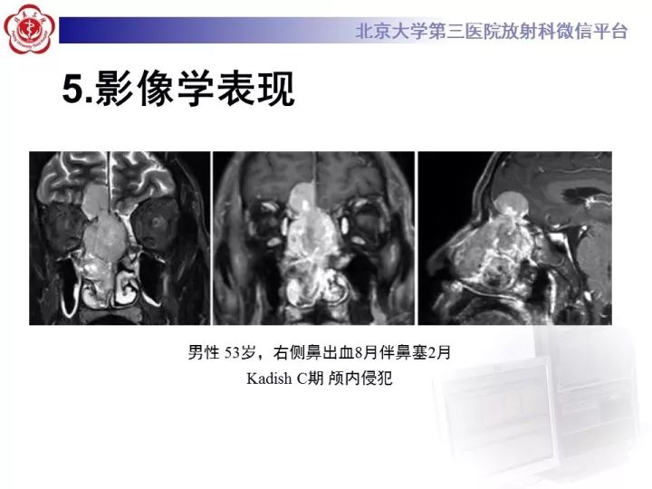 【病例】鼻腔嗅神经母细胞瘤1例CT及MR影像
