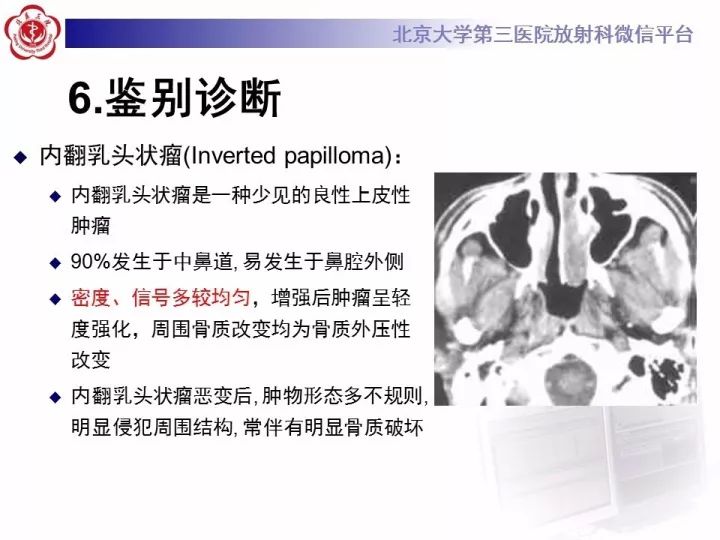 【病例】鼻腔嗅神经母细胞瘤1例CT及MR影像