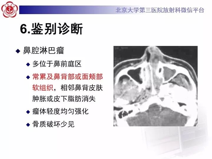【病例】鼻腔嗅神经母细胞瘤1例CT及MR影像