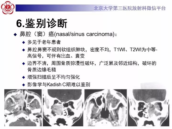 【病例】鼻腔嗅神经母细胞瘤1例CT及MR影像