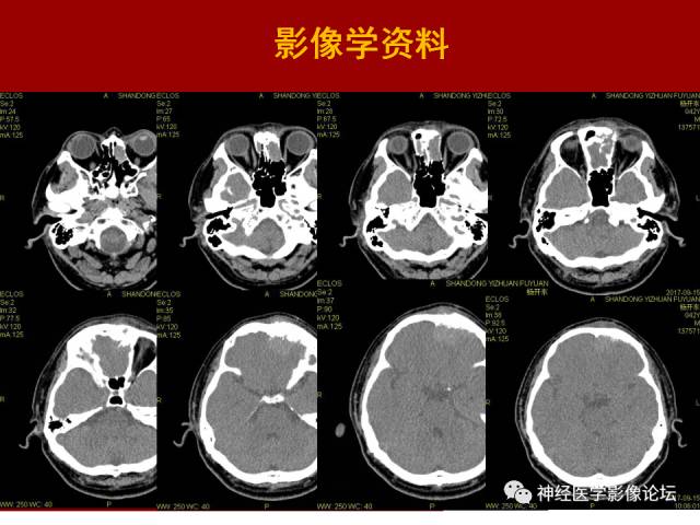 【病例】鼻颅沟通肿瘤——嗅神经母细胞瘤一例MR