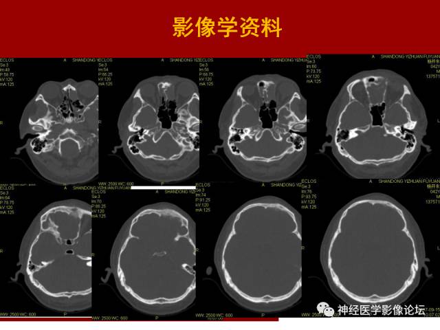 【病例】鼻颅沟通肿瘤——嗅神经母细胞瘤一例MR