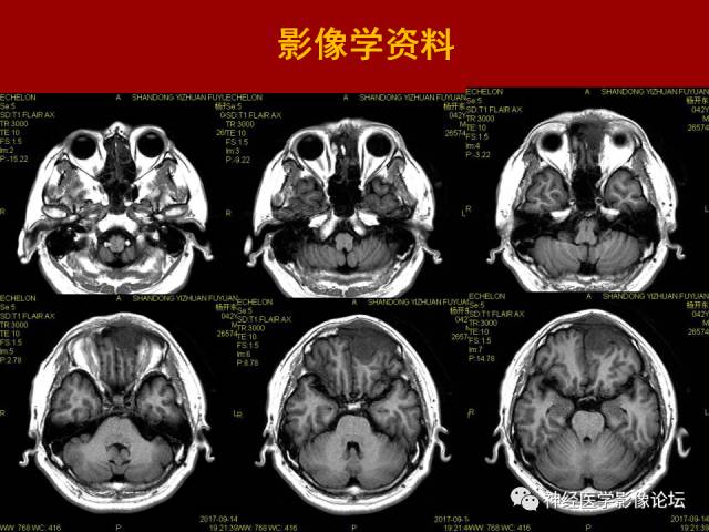 【病例】鼻颅沟通肿瘤——嗅神经母细胞瘤一例MR