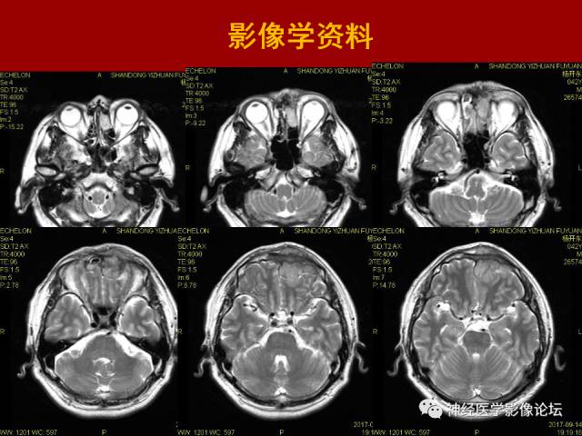 【病例】鼻颅沟通肿瘤——嗅神经母细胞瘤一例MR