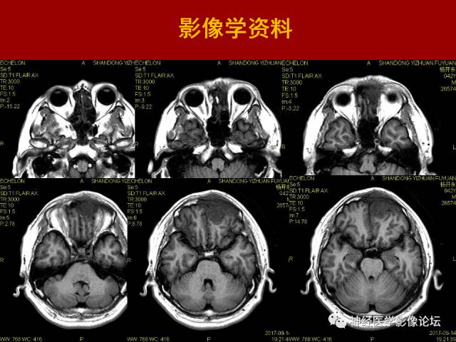 【病例】鼻颅沟通肿瘤——嗅神经母细胞瘤一例MR