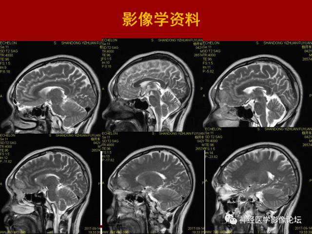 【病例】鼻颅沟通肿瘤——嗅神经母细胞瘤一例MR