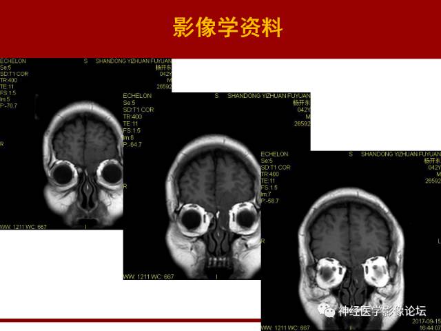 【病例】鼻颅沟通肿瘤——嗅神经母细胞瘤一例MR