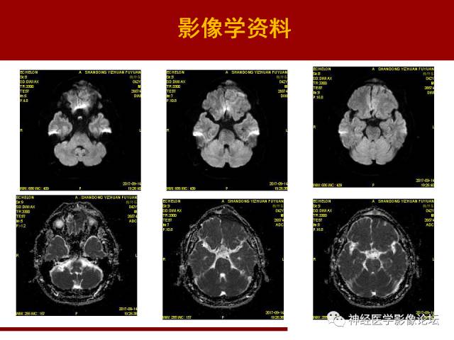 【病例】鼻颅沟通肿瘤——嗅神经母细胞瘤一例MR