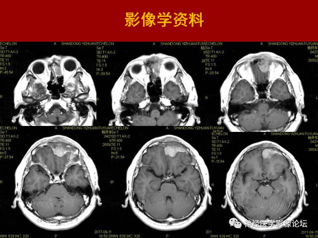 【病例】鼻颅沟通肿瘤——嗅神经母细胞瘤一例MR