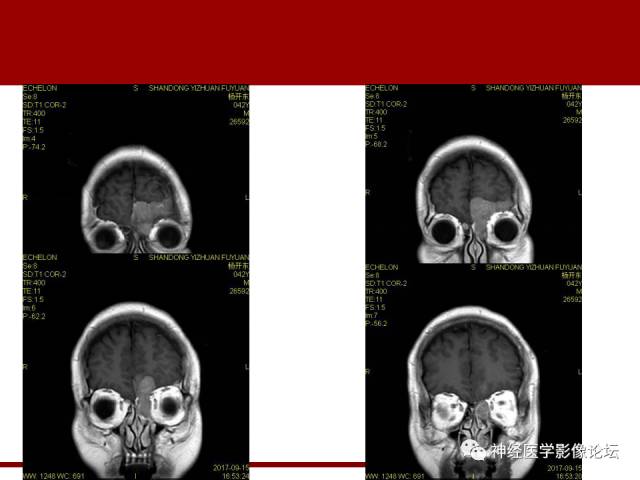 【病例】鼻颅沟通肿瘤——嗅神经母细胞瘤一例MR
