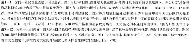 【病例】肝脏硬化性血管瘤1例CT及MRI表现