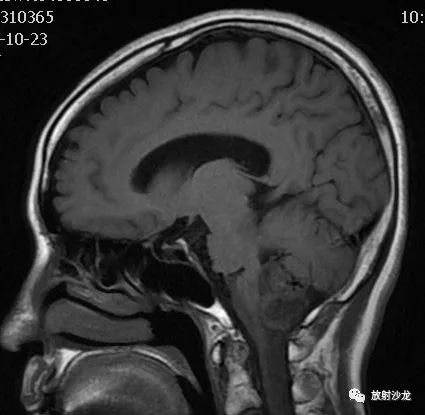 【病例】后颅窝血管母细胞瘤1例MR影像表现 【病例】后颅窝血管母细胞瘤1例MR影像表现