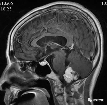 【病例】后颅窝血管母细胞瘤1例MR影像表现 【病例】后颅窝血管母细胞瘤1例MR影像表现