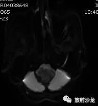 【病例】后颅窝血管母细胞瘤1例MR影像表现 【病例】后颅窝血管母细胞瘤1例MR影像表现