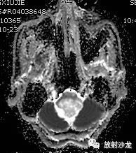 【病例】后颅窝血管母细胞瘤1例MR影像表现 【病例】后颅窝血管母细胞瘤1例MR影像表现