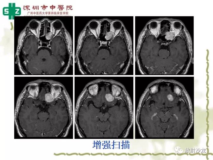 【病例】左侧眶尖血管外皮细胞瘤1例CT及MR