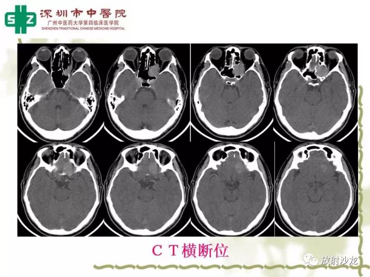 【病例】左侧眶尖血管外皮细胞瘤1例CT及MR