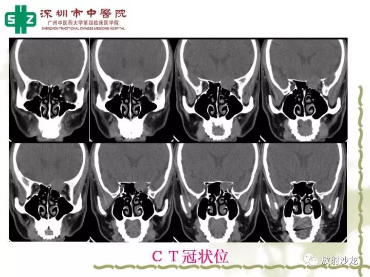 【病例】左侧眶尖血管外皮细胞瘤1例CT及MR