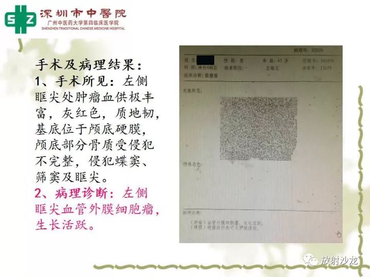 【病例】左侧眶尖血管外皮细胞瘤1例CT及MR