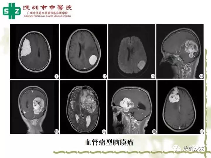 【病例】左侧眶尖血管外皮细胞瘤1例CT及MR