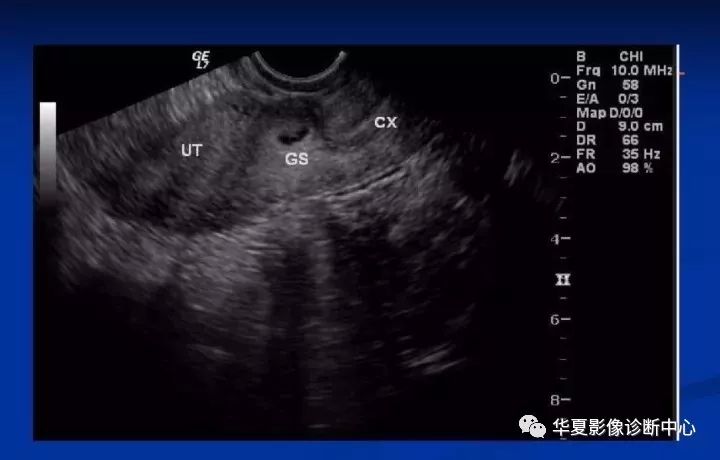 【病例】瘢痕妊娠1例MR