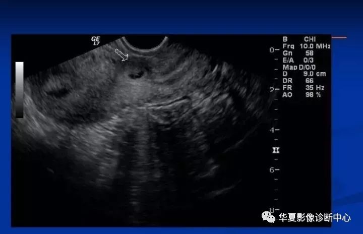 【病例】瘢痕妊娠1例MR