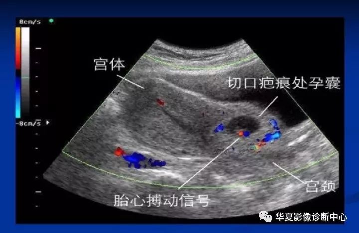 【病例】瘢痕妊娠1例MR