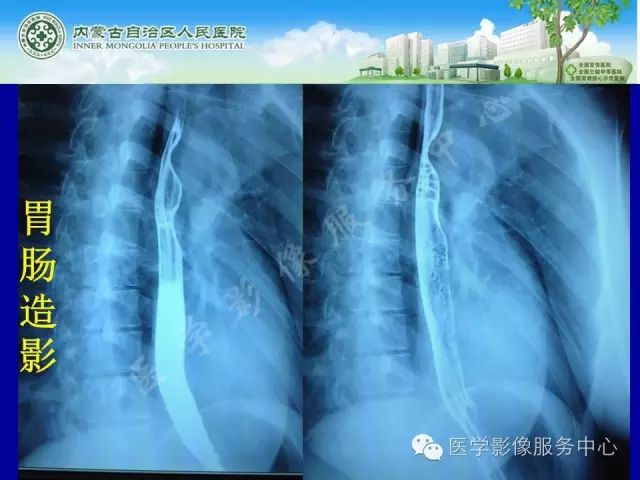 【罕见病例】全球仅22例的深在性囊性胃炎1例CT影像