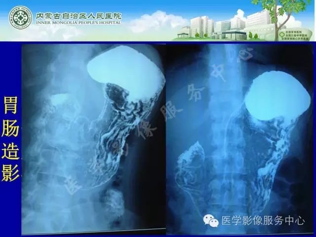 【罕见病例】全球仅22例的深在性囊性胃炎1例CT影像