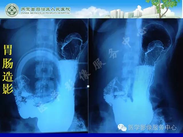 【罕见病例】全球仅22例的深在性囊性胃炎1例CT影像